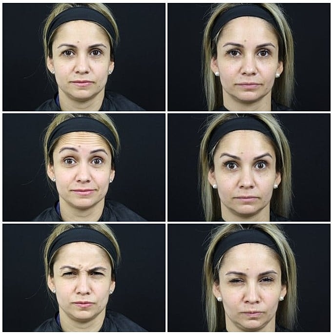 Before and after Dysport treatment Miami
