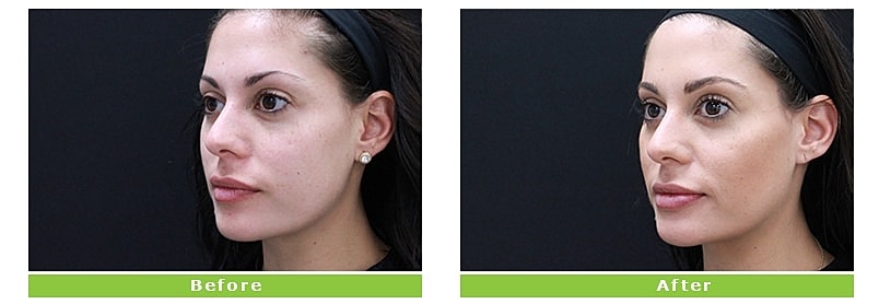 Before and after facial enhancement comparison.