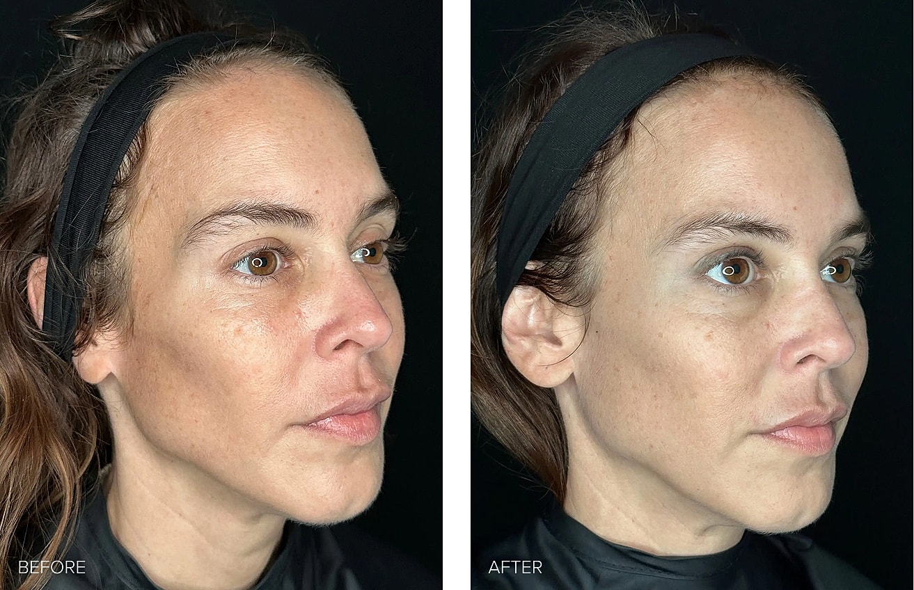 Before and after beauty treatment comparison image.