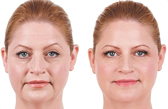 Before and after facial rejuvenation treatment comparison.