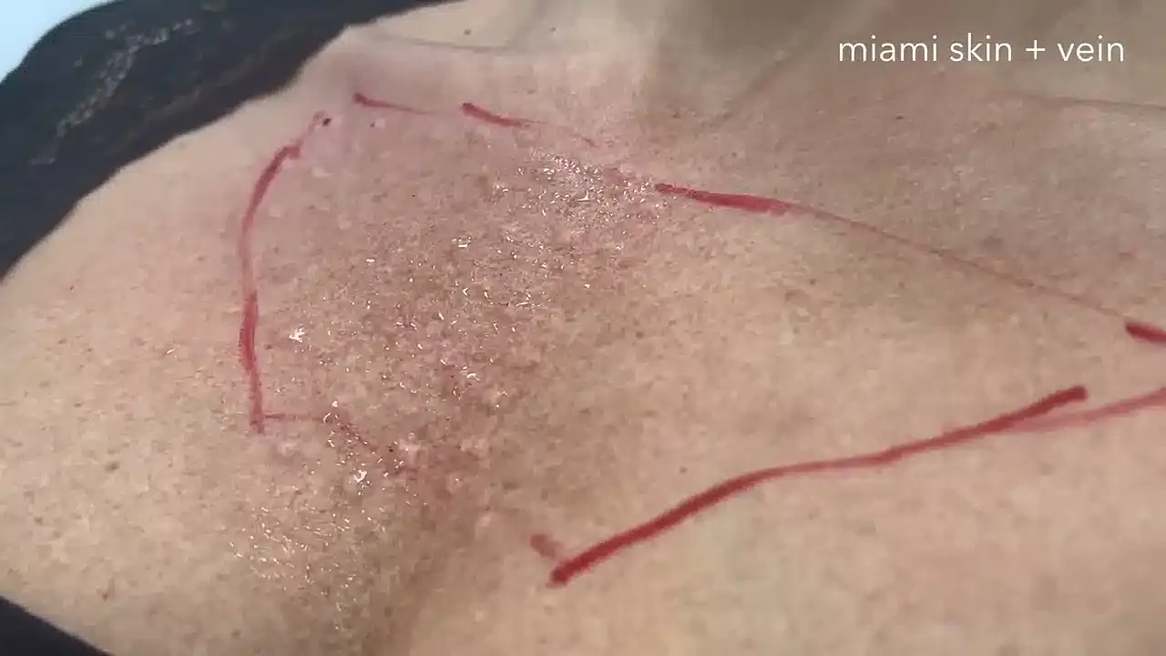 Skin with marked areas for treatment procedure.