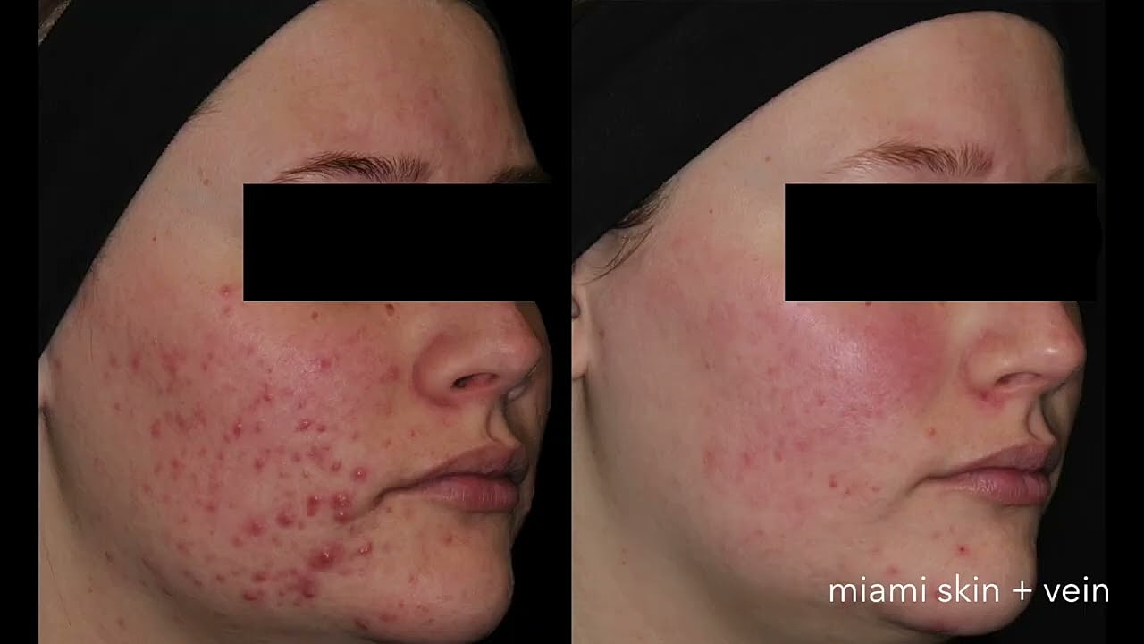 Before and after acne treatment comparison.