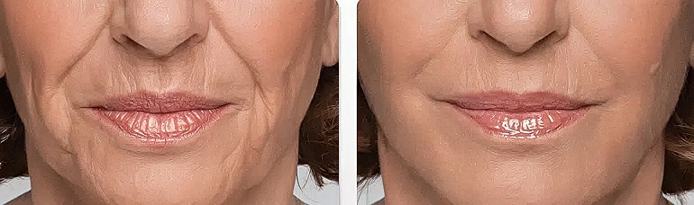 Before and after skin smoothing comparison.