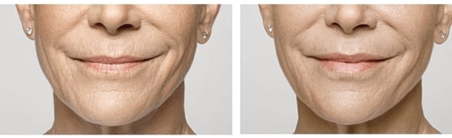 before after Restylane Miami