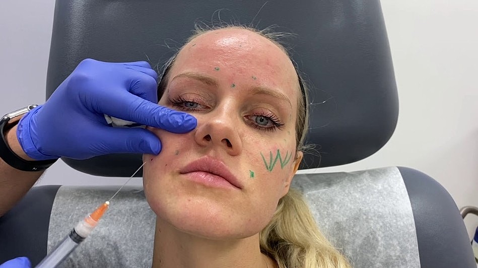 Cosmetic procedure with syringe and marked face.