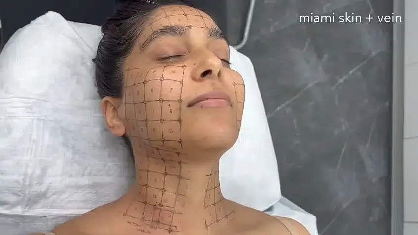 Facial treatment with grid markings for precision.