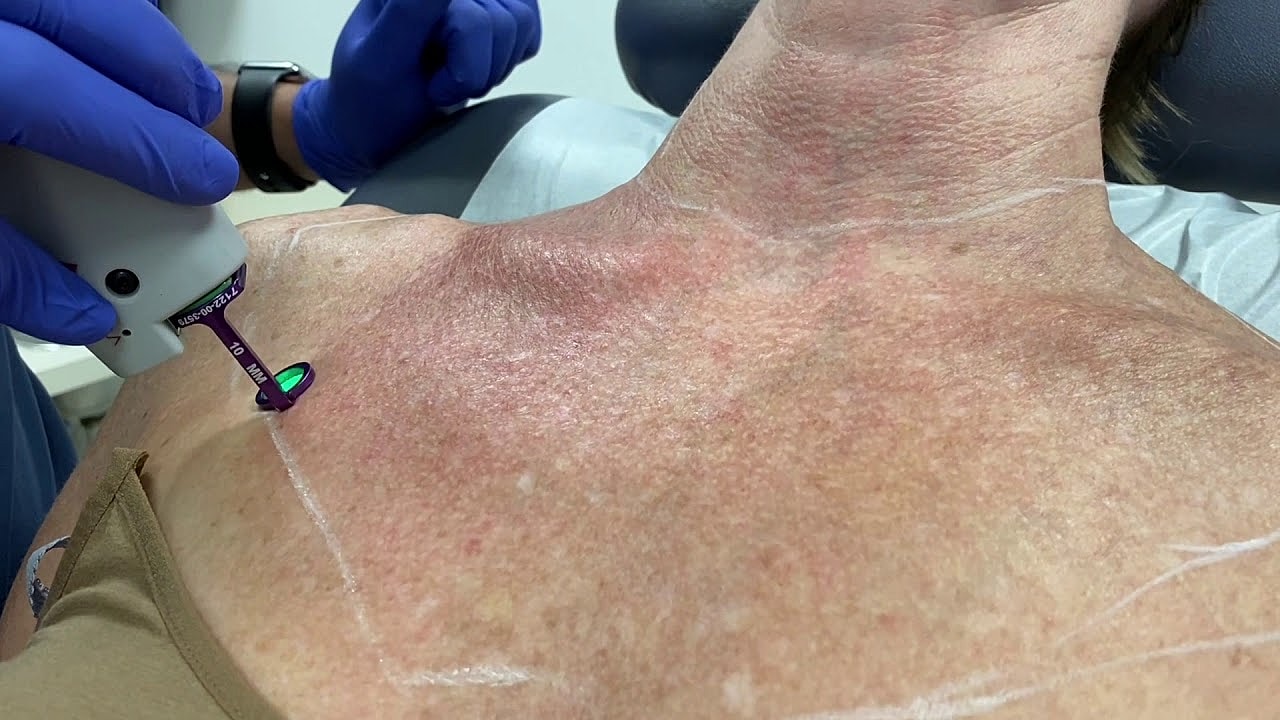 Laser treatment on skin for cosmetic purposes.