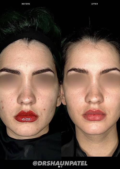 Before and after skin treatment transformation.